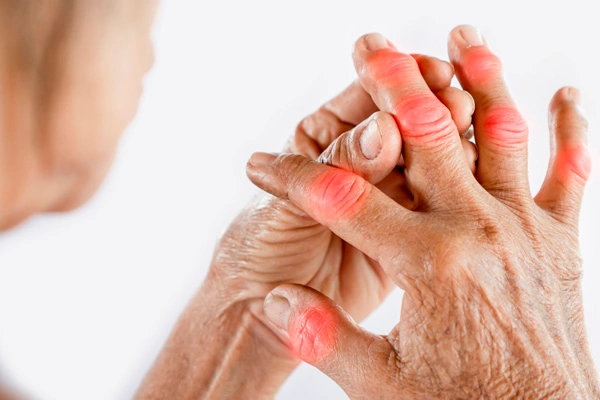 Ist rheumatoide Arthritis genetisch bedingt?