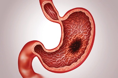 Gastrointestinal tract cancer
