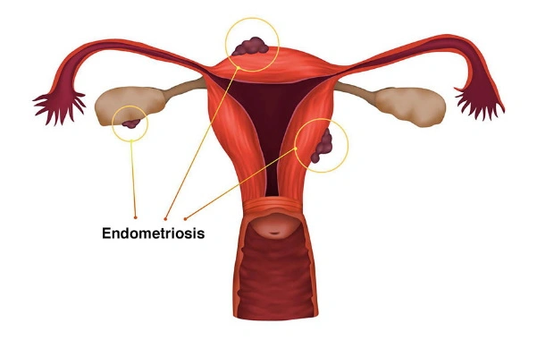 Genes de la endometriosis