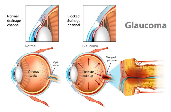 El glaucoma es hereditario