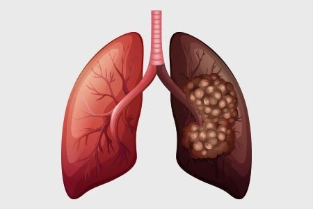 Genético del cáncer de pulmón.