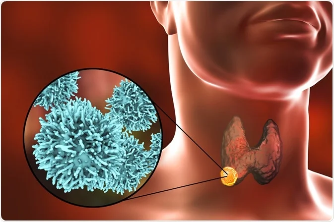 Test genetici per il cancro alla tiroide